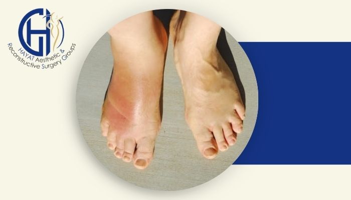 آیا لیپوماتیک خطر آمبولی دارد و چگونه می‌توان از آن پیشگیری کرد؟