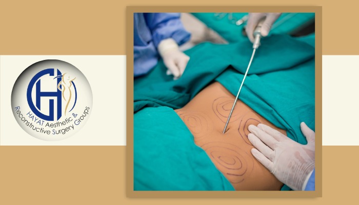 آیا نتیجه پیکرتراشی دائمی است؟