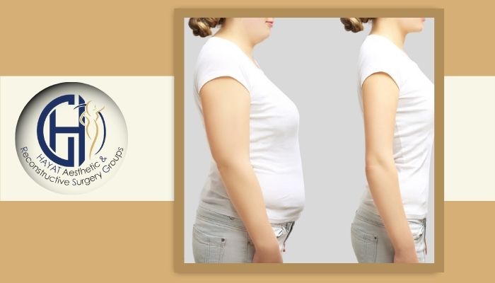اسلیو معده یا پیکرتراشی؟ مقایسه کامل این دو روش