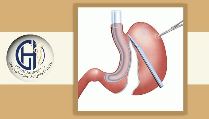مزایای اسلیو معده و پیکرتراشی
