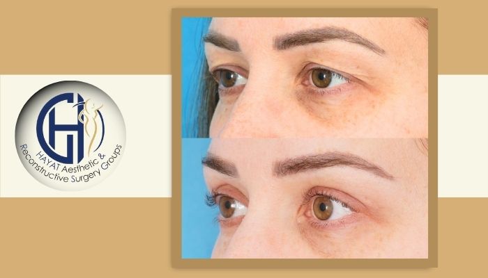مقایسه بلفاروپلاستی با لیزر و جراحی سنتی مقایسه بلفاروپلاستی با لیزر و جراحی سنتی