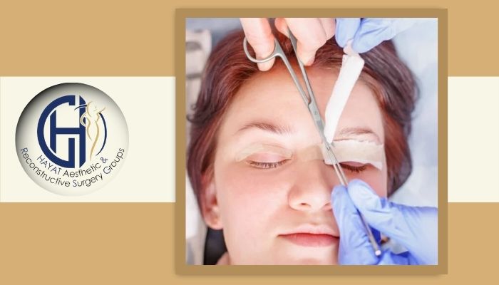 زمان بازگشت به فعالیت بعد از جراحی پلک