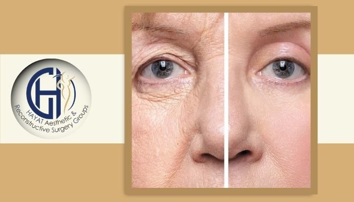 مراحل بهبودی پس از بلفاروپلاستی 