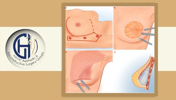 عوامل مؤثر بر تغییر حس بعد از جراحی سینه عوامل مؤثر بر تغییر حس بعد از جراحی سینه