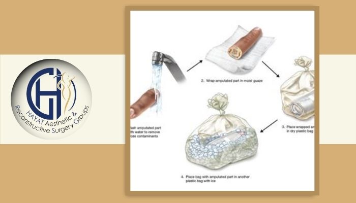 نگهداری درست انگشت قطع‌شده چگونه است؟ 