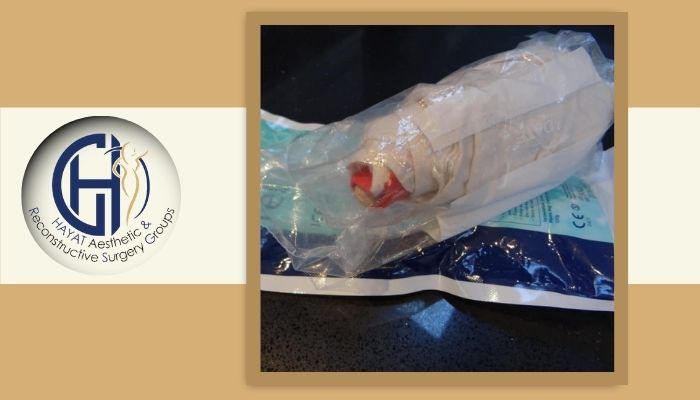 پیوند انگشت برای چه کسانی مناسب است؟ 