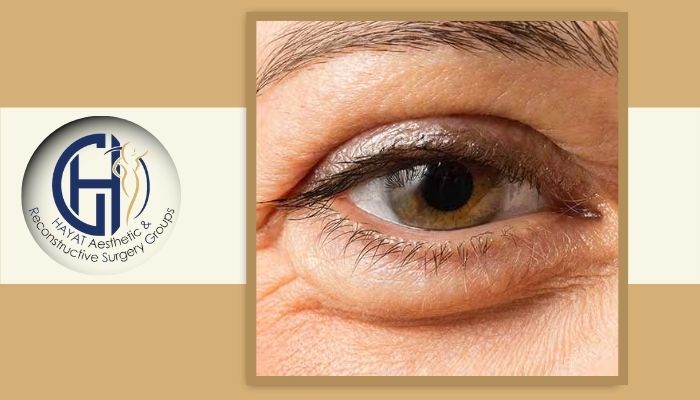 زمان عمل پف زیر چشم