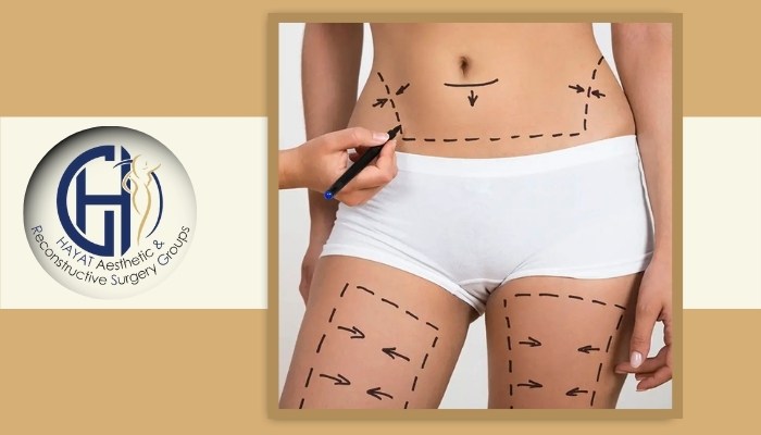 افزایش وزن بعد از لیپو افزایش وزن بعد از لیپو