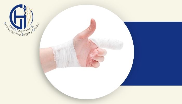 آیا انگشت قطع‌ شده دست دوباره قابل پیوند است؟