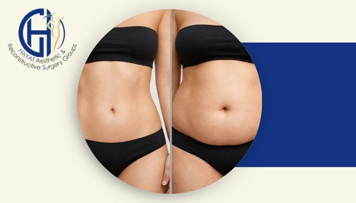 اگر بعد از لیپوماتیک دوباره چاق شوم چه اتفاقی می‌افتد؟