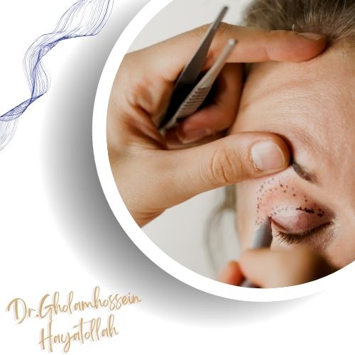 بلفاروپلاستی چیست؟