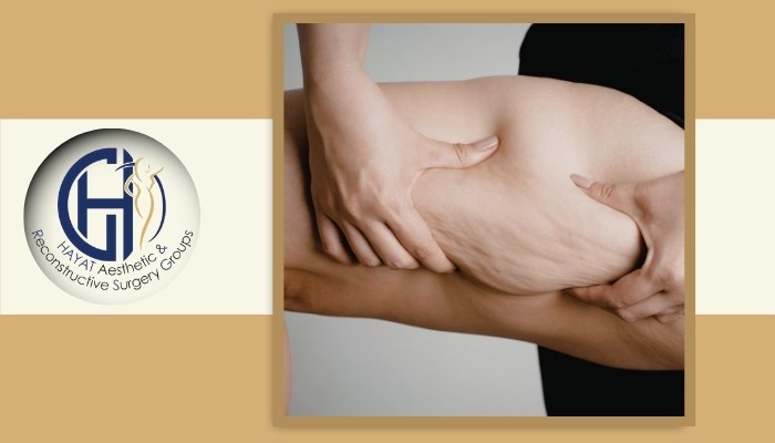 جلوگیری از افزایش وزن بعد از لیپو جلوگیری از افزایش وزن بعد از لیپو