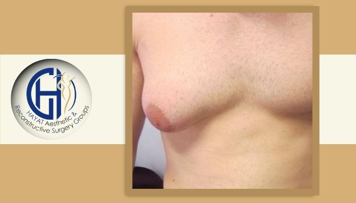 ژنیکوماستی چه علائمی دارد؟