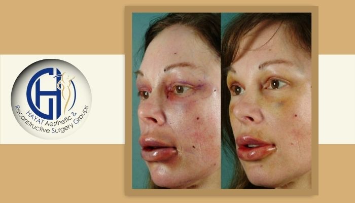 عوارض و خطرات احتمالی تزریق چربی به صورت عوارض و خطرات احتمالی تزریق چربی به صورت