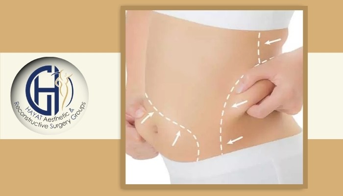 عوارض چاقی بعد از لیپوماتیک عوارض چاقی بعد از لیپوماتیک