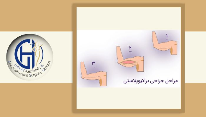 نحوه انجام لیفت و جراحی بازو