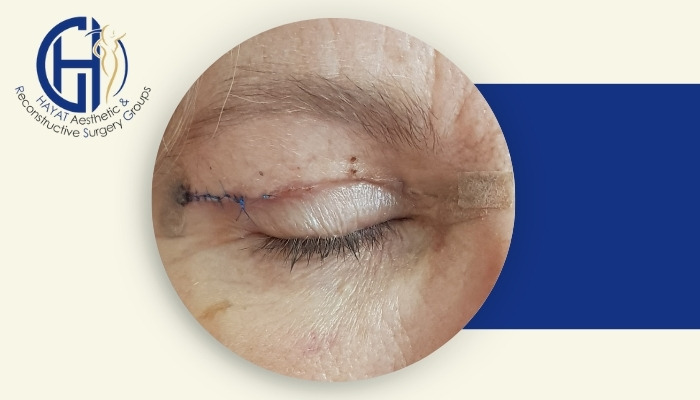 چرا برخی افراد بعد از جراحی پلک احساس سنگینی چشم دارند؟ چرا برخی افراد بعد از جراحی پلک احساس سنگینی چشم دارند؟