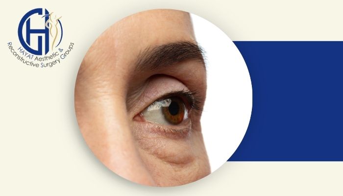 چه زمانی باید برای عمل پف زیر چشم اقدام کرد؟