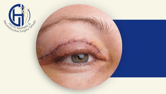 چه مدت پس از جراحی پلک می‌توان فعالیت روزمره را آغاز کرد؟