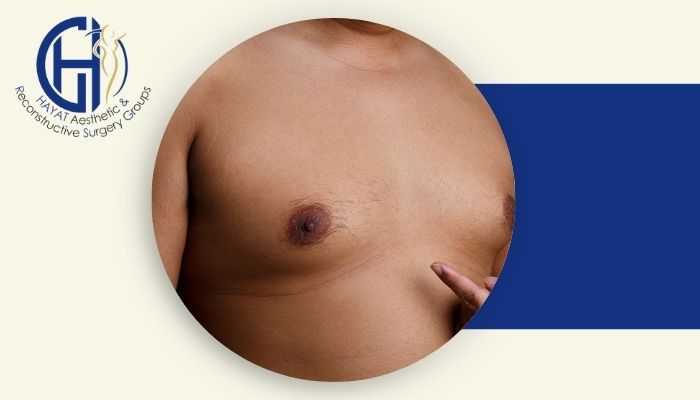ژنیکوماستی چیست و بهترین جراح آن