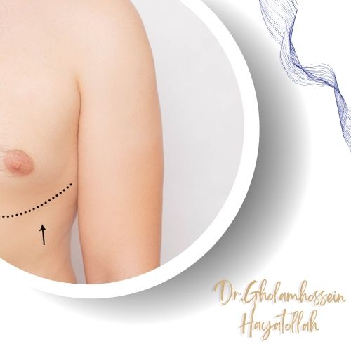دلایل انجام جراحی ژنیکوماستی