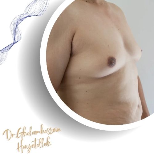 ژنیکوماستی ژنیکوماستی