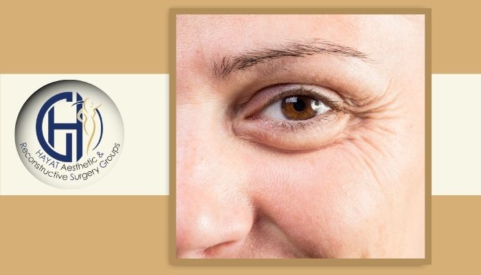 تاثیر بلفاروپلاستی پلک بالا و پایین بر ظاهر چشم تاثیر بلفاروپلاستی پلک بالا و پایین بر ظاهر چشم